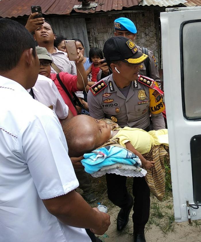 Indah Penderita Hydrocepalus Berangkat Berobat ke Medan