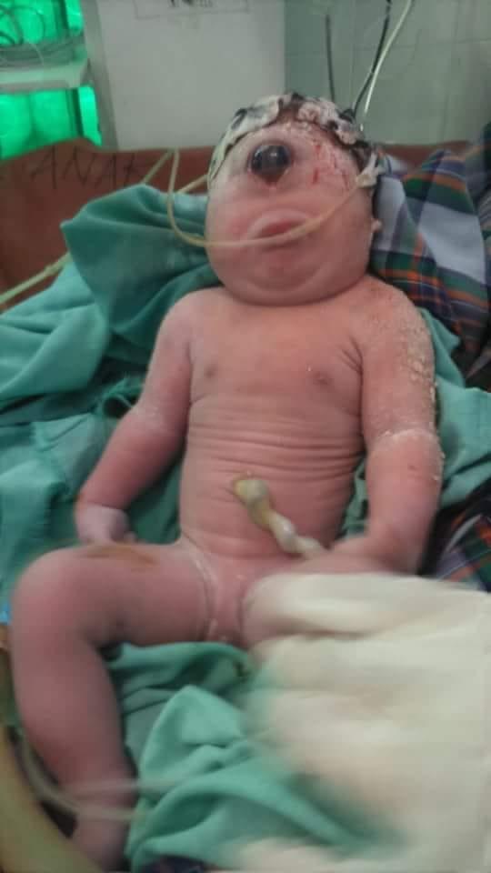 Bayi Mata Satu Lahir di RSU Panyabungan Madina 