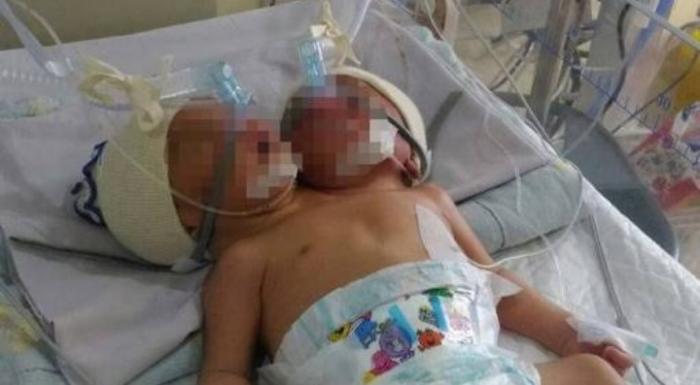 Pasca Operasi, Kedua Bayi Kembar Siam Masih Kritis
