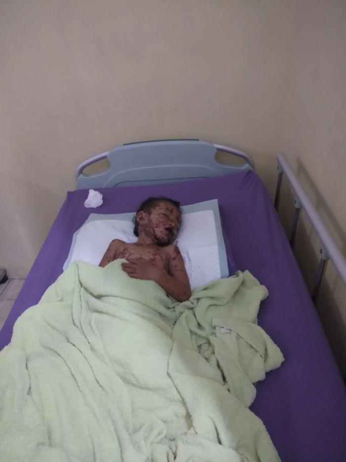 Diduga Mallpraktek, Sekujur Tubuh Bocah 4 Tahun Ini Melepuh